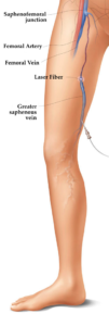 VenaCure_EVLT_in_leg_with_anatomy1_1